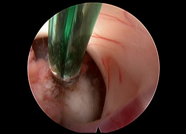 Endoscopic Brain and Spine Surgery