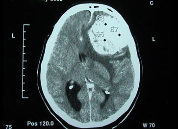 Endoscopic Brain and Spine Surgery
