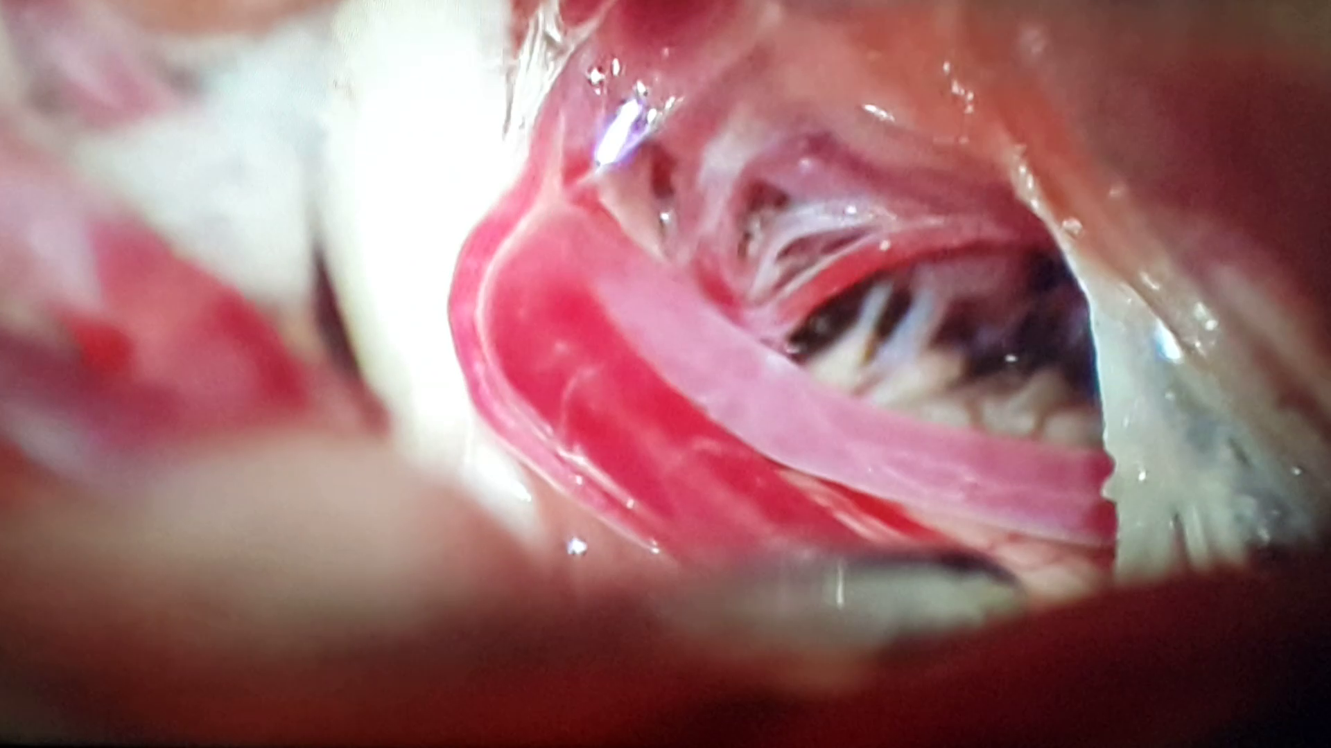 Endoscopic Brain and Spine Surgery